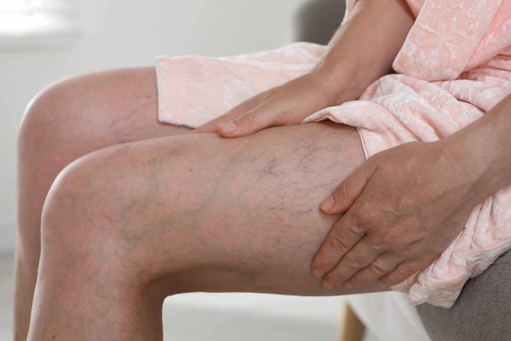 Varicose Veins