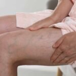 Varicose Veins