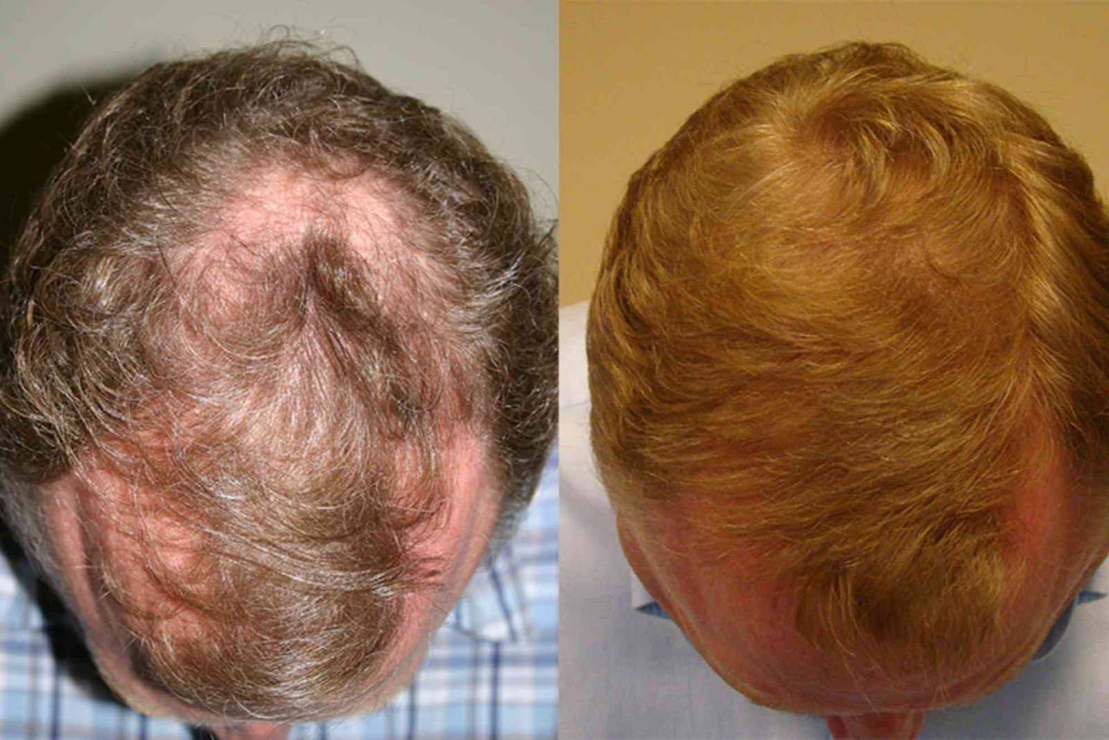 Best Hair Transplat Turkey